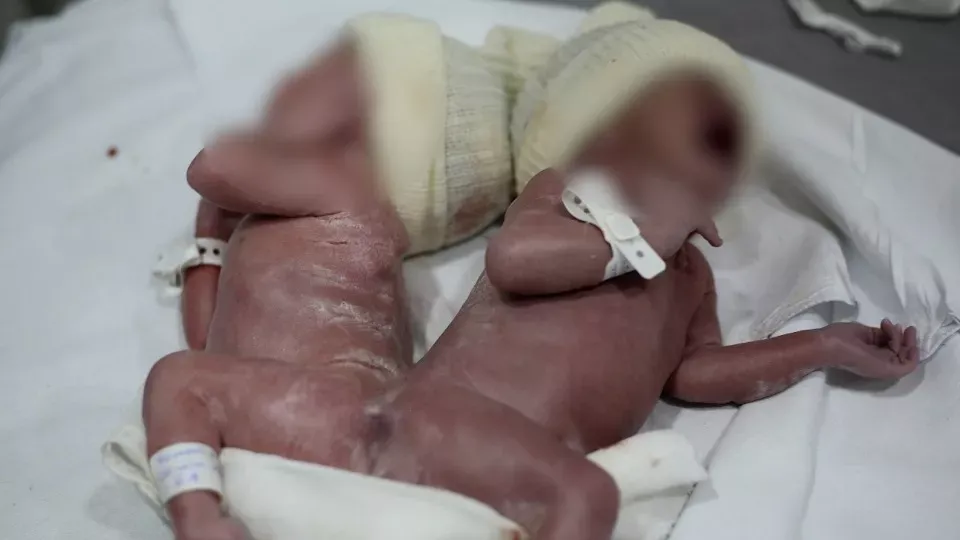 Gêmeos siameses nascem em parto raríssimo em Campo Largo