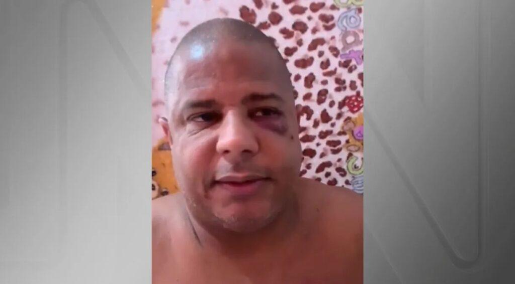 Ex-Jogador Marcelinho Carioca aparece com olho roxo em vídeo: “Saí com mulher casada e o marido me sequestrou”