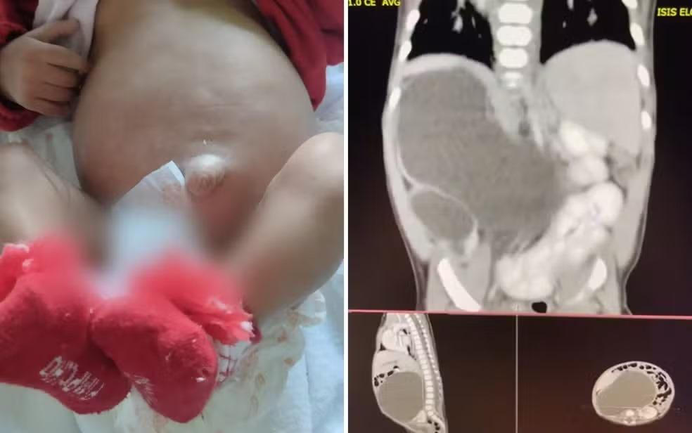 Bebê que nasceu com quatro rins em Goiás; caso é considerado raro por médicos: ‘cerca de 100 registrados no mundo’
