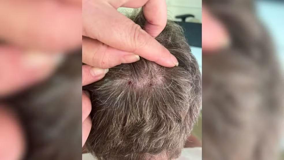 Homem é picado por cobra na cabeça durante manutenção de cerca elétrica